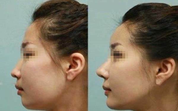 沈陽(yáng)哪里可以做韓式<a href=http://www.f3bb6.cn/listinfo-737-0.html target=_blank class=infotextkey>隆鼻</a>