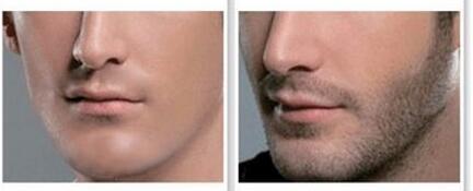 胡須種植術安全嗎