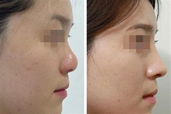 韓式<a href=http://www.f3bb6.cn/listinfo-737-0.html target=_blank class=infotextkey>隆鼻</a>前后對比圖