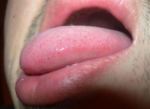 口腔尖銳濕怎么治