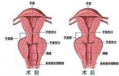 激光縮陰要做幾次