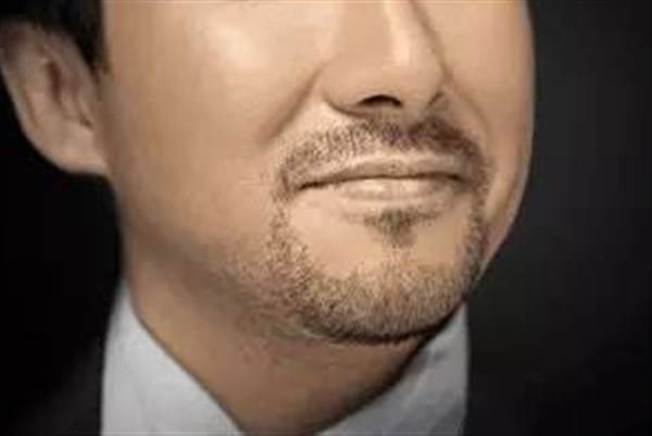 胡須種植手術要注意什么?