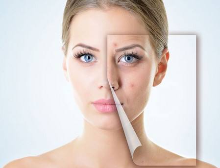 大連激光去痘的多少錢