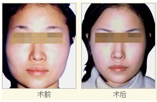 下頜削骨手術后遺癥