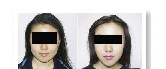 <a href=http://www.f3bb6.cn/listinfo-629-0.html target=_blank class=infotextkey>下頜角</a>手術(shù)下巴麻木怎么回事呢