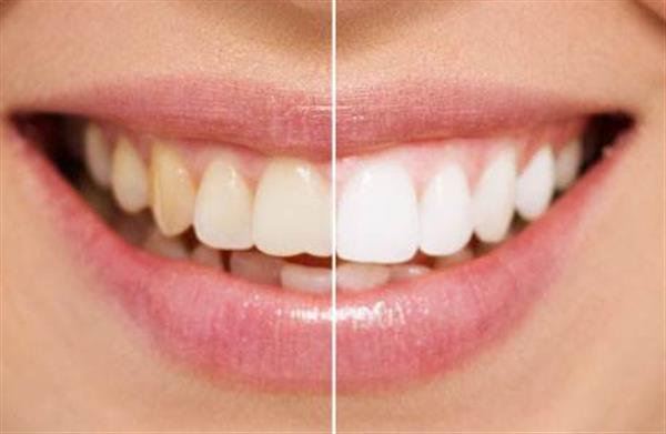 怎么變白牙齒呢