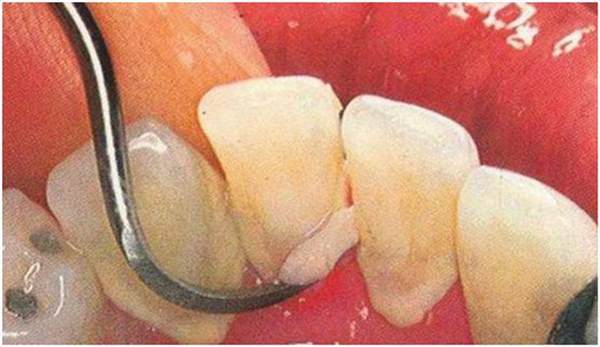 牙石掉了有個坑如何治療