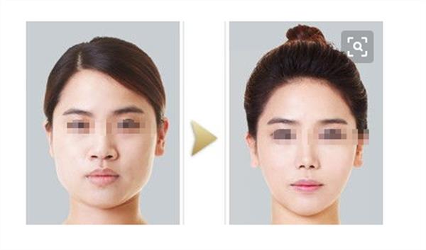 成都磨骨哪家醫院好