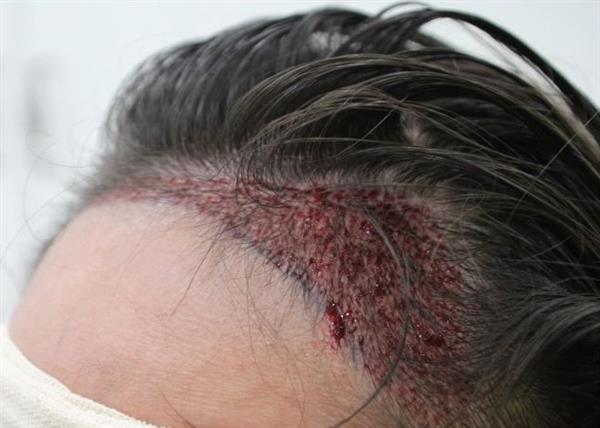 昆明頭發(fā)種植的價(jià)格