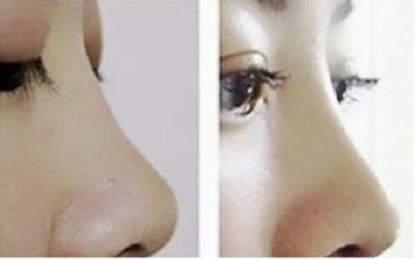 硅膠<a href=http://www.f3bb6.cn/listinfo-737-0.html target=_blank class=infotextkey>隆鼻</a>取出后能恢復原樣嗎