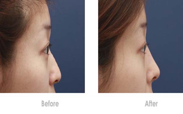 硅膠<a href=http://www.f3bb6.cn/listinfo-737-0.html target=_blank class=infotextkey>隆鼻</a>假體取出有沒有危險