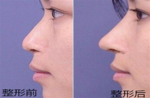 透明質酸<a href=http://www.f3bb6.cn/listinfo-737-0.html target=_blank class=infotextkey>隆鼻</a>前后恢復對比圖