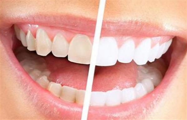 冷光美白要做幾次