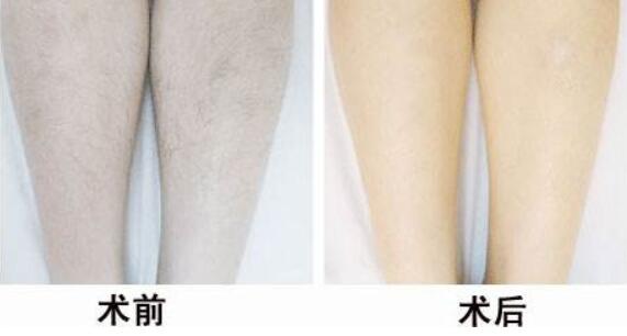 冰點<a href=http://www.f3bb6.cn/listinfo-670-0.html target=_blank class=infotextkey>脫毛</a>后的注意事項