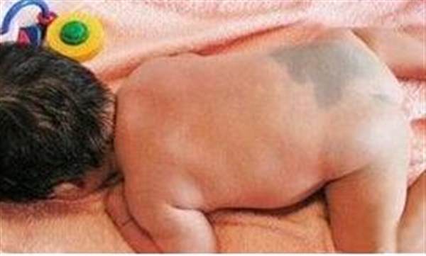 激光<a href=http://www.f3bb6.cn/listinfo-773-0.html target=_blank class=infotextkey>去胎記</a>后多久恢復