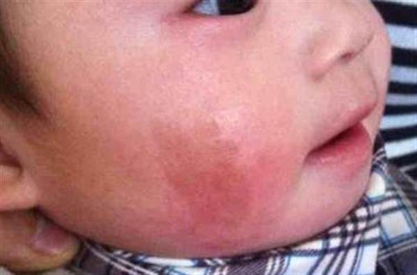 臉上胎記能去掉嗎