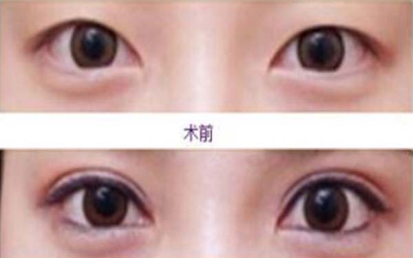 埋線<a href=http://www.f3bb6.cn/listinfo-724-0.html target=_blank class=infotextkey>雙眼皮</a>拆線多少錢