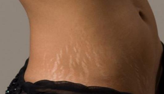 肚子妊娠紋怎么消除