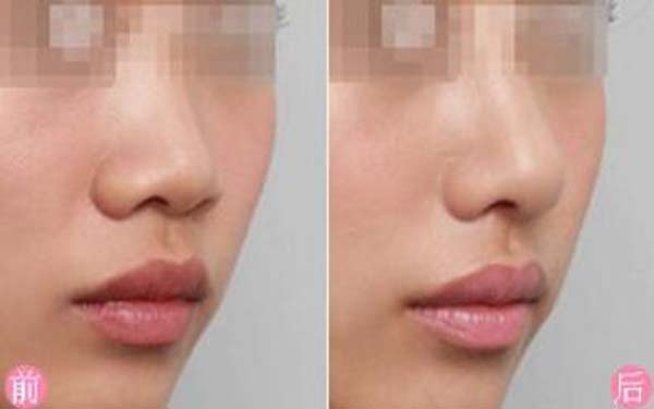 <a href=http://www.f3bb6.cn/listinfo-753-0.html target=_blank class=infotextkey>鼻頭縮小</a>和<a href=http://www.f3bb6.cn/listinfo-754-0.html target=_blank class=infotextkey>鼻翼</a>縮小術的區別