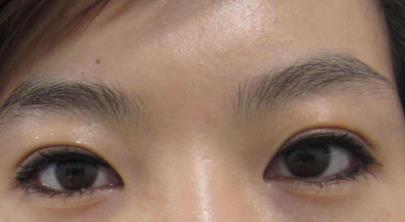 埋線<a href=http://www.f3bb6.cn/listinfo-724-0.html target=_blank class=infotextkey>雙眼皮</a>寬能改窄嗎