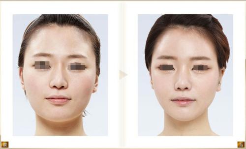 臉部磨骨需要多久恢復