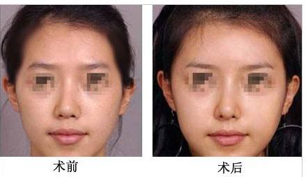 <a href=http://www.f3bb6.cn/listinfo-630-0.html target=_blank class=infotextkey>豐太陽(yáng)穴</a>大概多少錢