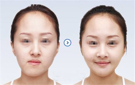 做<a href=http://www.f3bb6.cn/listinfo-632-0.html target=_blank class=infotextkey>正頜</a>手術(shù)多少錢