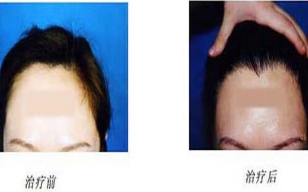 <a href=http://www.f3bb6.cn/listinfo-669-0.html target=_blank class=infotextkey>美人尖種植</a>的過程及護理方式