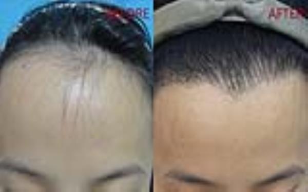 <a href=http://www.f3bb6.cn/listinfo-669-0.html target=_blank class=infotextkey>美人尖種植</a>的安全性及術(shù)后護(hù)理方式