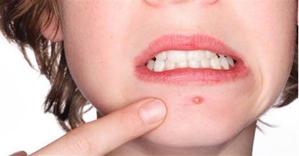 <a href=http://www.f3bb6.cn/listinfo-769-0.html target=_blank class=infotextkey>去黑頭</a>粉刺有效的方法