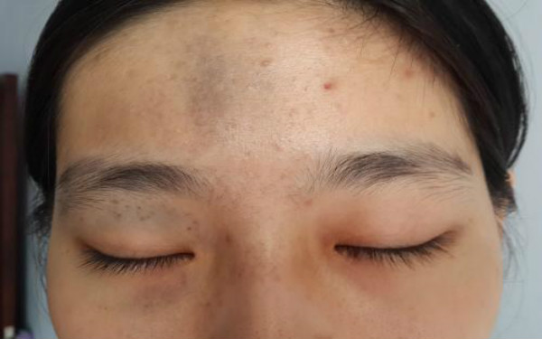 怎樣去掉黑胎記