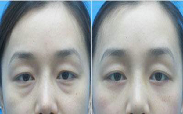 內陸眼袋后遺癥