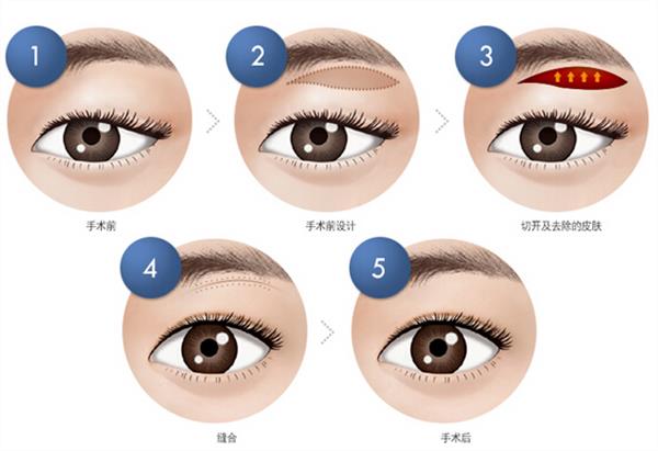 做<a href=http://www.f3bb6.cn/listinfo-655-0.html target=_blank class=infotextkey>切眉</a>手術有什么壞處