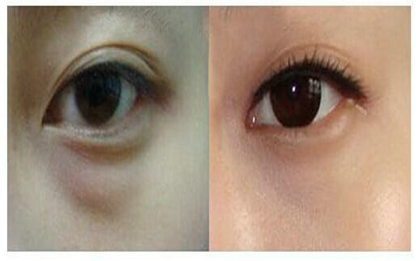 內切割眼袋能維持多久?