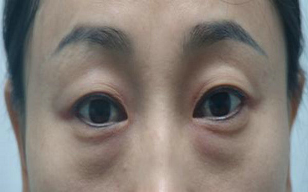 內切<a href=http://www.f3bb6.cn/listinfo-708-0.html target=_blank class=infotextkey>去眼袋</a>費用