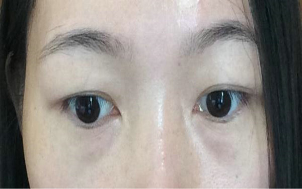 內(nèi)切<a href=http://www.f3bb6.cn/listinfo-708-0.html target=_blank class=infotextkey>去眼袋</a>去哪個醫(yī)院?