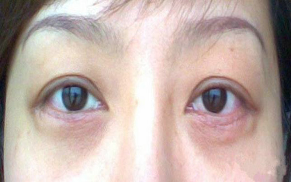 內切眼袋傷口多久愈合?