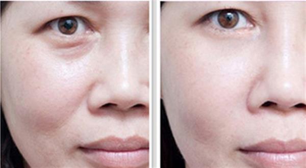 抽脂法<a href=http://www.f3bb6.cn/listinfo-708-0.html target=_blank class=infotextkey>去眼袋</a>能維持多久