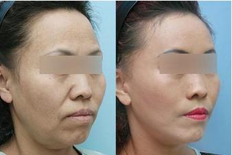  拉皮<a href=http://www.f3bb6.cn/listinfo-614-0.html target=_blank class=infotextkey>除皺</a>的價格