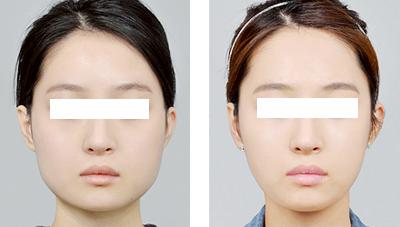 <a href=http://www.f3bb6.cn/listinfo-631-0.html target=_blank class=infotextkey>瘦臉</a><a href=http://www.f3bb6.cn/listinfo-614-0.html target=_blank class=infotextkey>除皺</a>打幾次才能定型