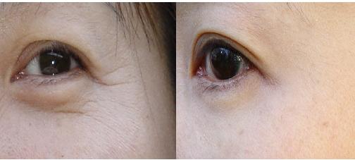 什么是<a href=http://www.f3bb6.cn/listinfo-614-0.html target=_blank class=infotextkey>除皺</a>抗衰