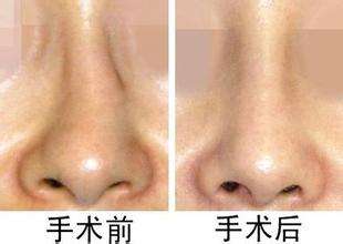 <a href=http://www.f3bb6.cn/listinfo-751-0.html target=_blank class=infotextkey>歪鼻矯正</a>手術后遺癥及禁忌