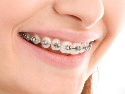 <a href=http://www.f3bb6.cn/listinfo-824-0.html target=_blank class=infotextkey>牙齒矯正</a>的年齡