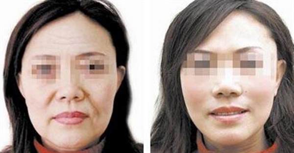 開刀拉皮手術過程