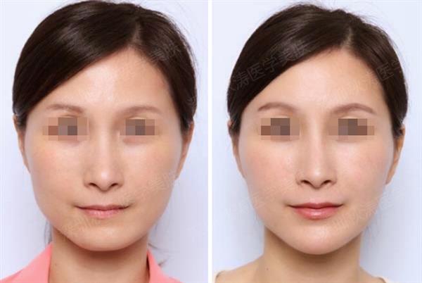 透明質(zhì)酸<a href=http://www.f3bb6.cn/listinfo-645-0.html target=_blank class=infotextkey>豐蘋(píng)果肌</a>下垂了可以恢復(fù)嗎