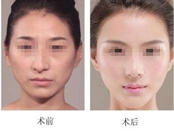 <a href=http://www.f3bb6.cn/listinfo-751-0.html target=_blank class=infotextkey>歪鼻矯正</a>的手術方式及價格