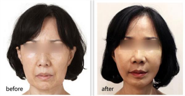 做完拉皮手術維持多久