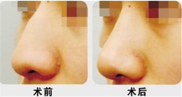 <a href=http://www.f3bb6.cn/listinfo-756-0.html target=_blank class=infotextkey>駝峰鼻矯正</a>手術禁忌人群