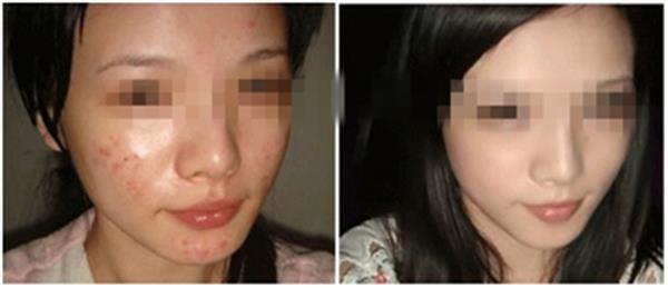 有效祛痘方法