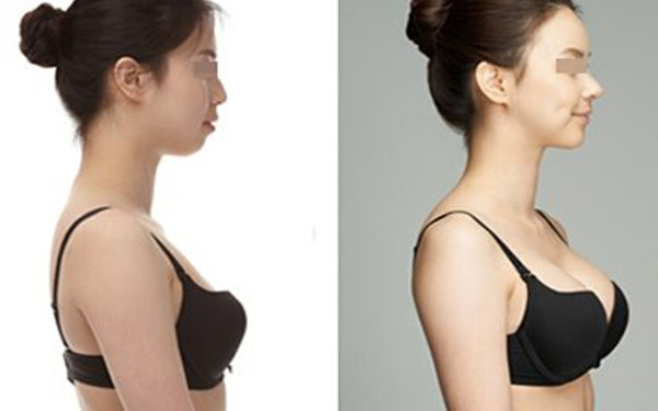 自體豐胸有什么危害